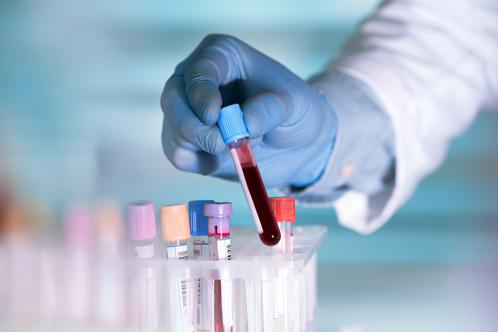 Fiala per esame del sangue: esempio di esame del sangue per individuare Alzheimer